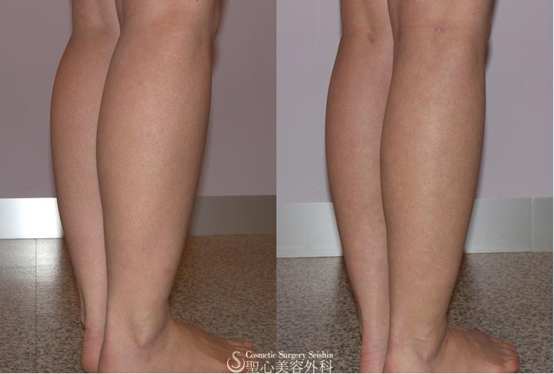 【術後経過】　ふくらはぎ脂肪吸引 After 