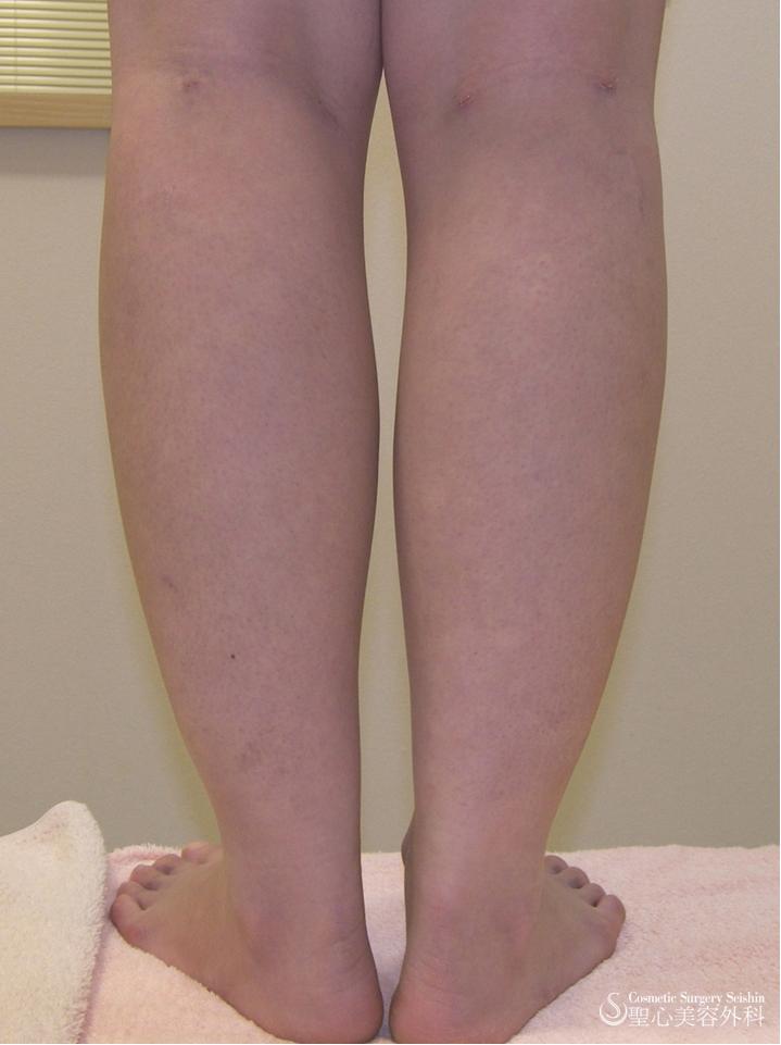 【術後経過】　ふくらはぎ脂肪吸引 After 