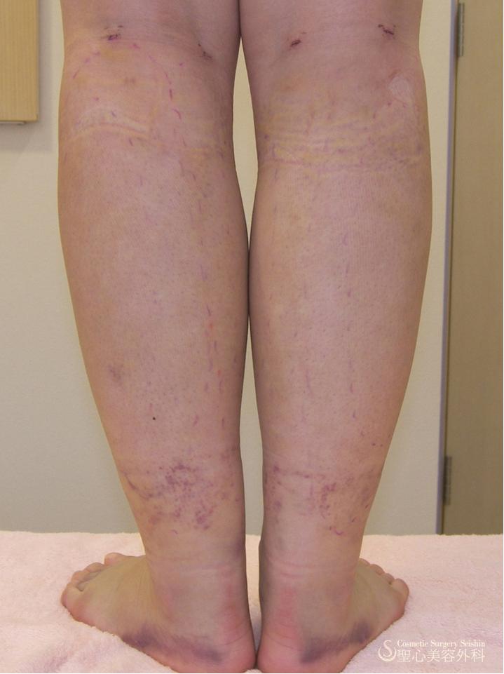 【術後経過】　ふくらはぎ脂肪吸引 After 
