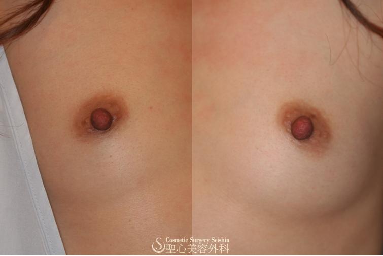 乳頭縮小 Before 