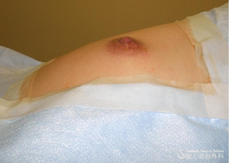 乳頭縮小 After 