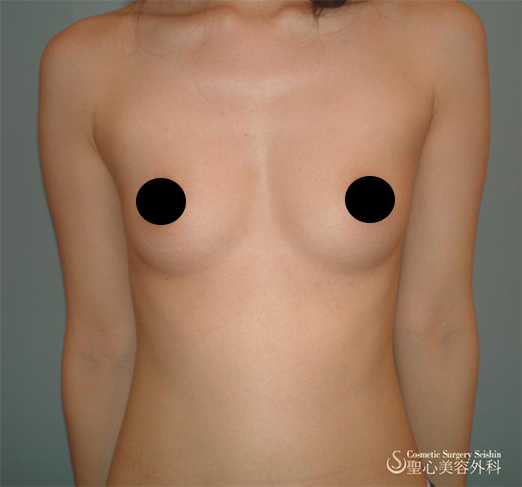 セリューション豊胸術＋プレミアムPRP注入 Before 