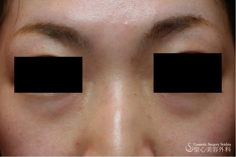 ヒアルロニダーゼ 鼻ヒアルロン酸注射後の修正 他院修正 症例写真 美容整形 美容外科なら聖心美容クリニック