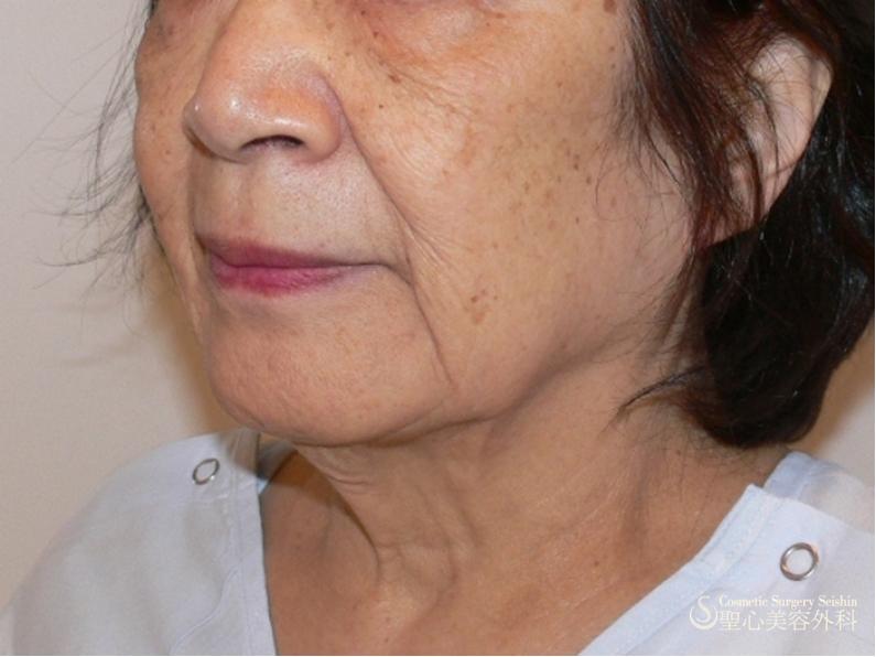 フェイスリフト Before 