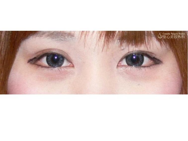 目頭修正 もうこヒダ形成 症例写真 美容整形 美容外科なら聖心美容クリニック