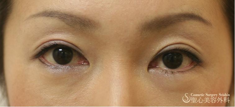眼瞼下垂 埋没法 症例写真 美容整形 美容外科なら聖心美容クリニック 眼瞼下垂 埋没法 症例写真 美容整形 美容外科なら聖心美容クリニック