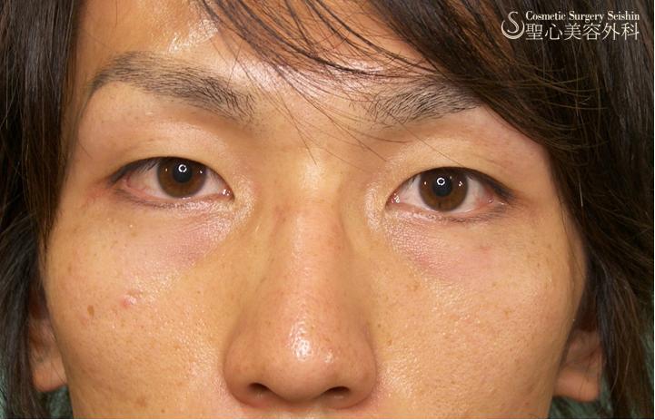【二重埋没法・20代男性】 Before 