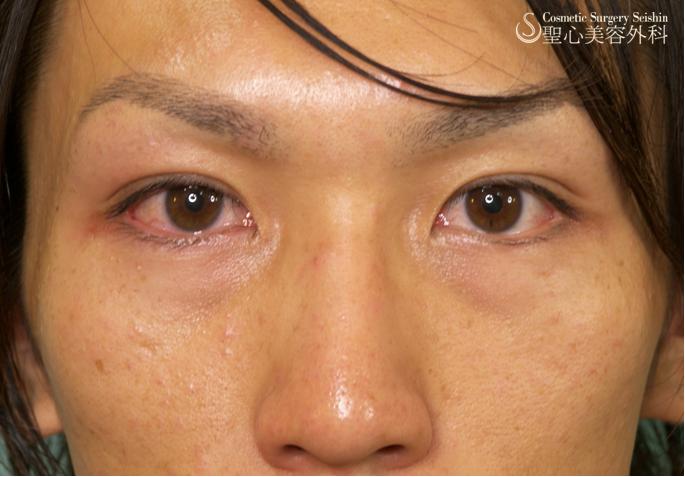【二重埋没法・20代男性】 After 