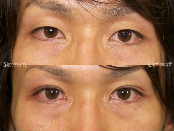 【二重埋没法・20代男性】 After 