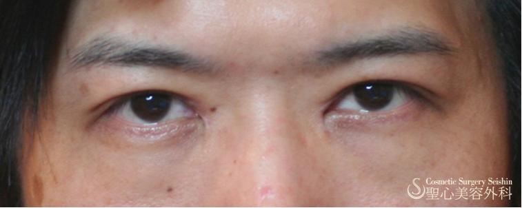 二重切開法 目頭切開 症例写真 美容整形 美容外科なら聖心美容クリニック