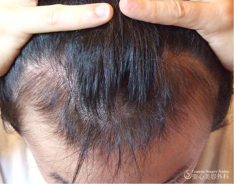 【30代男性：M字の薄毛】毛髪再生療法（3回治療後） After 