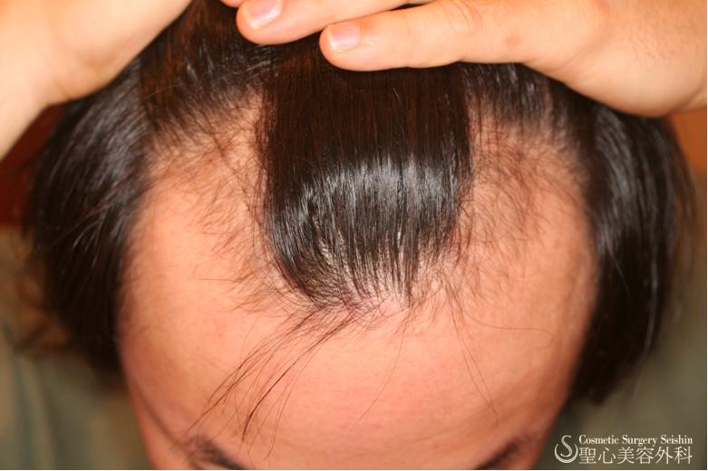 【30代男性：M字の薄毛】毛髪再生療法（3回治療後） Before 