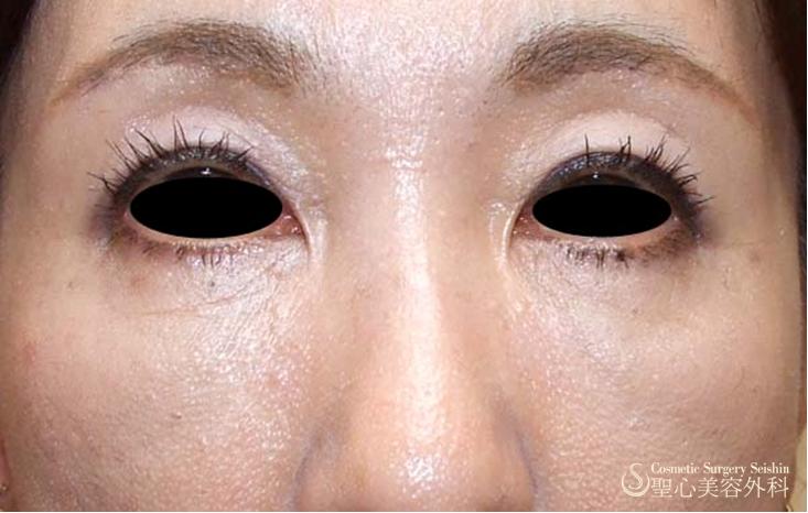 眉下切開、プレミアムPRP - 症例写真 - 美容整形、美容外科なら ...