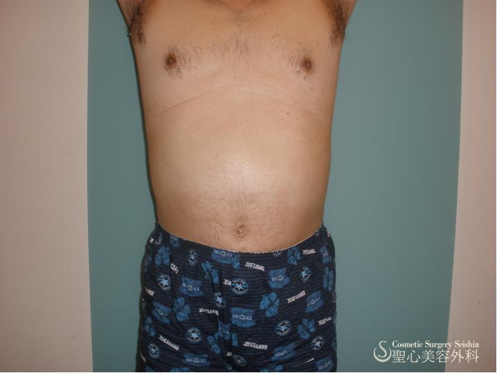 男性の腹部ボディジェット After 