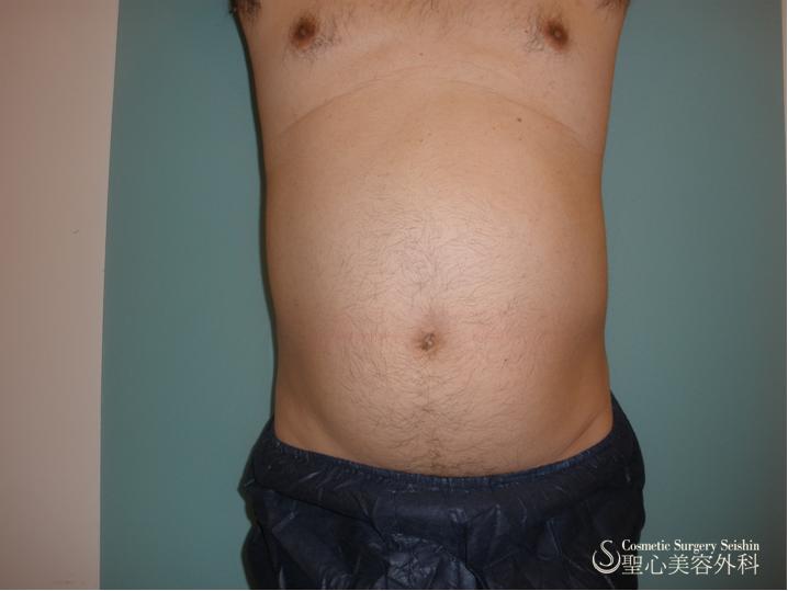 男性の腹部ボディジェット Before 