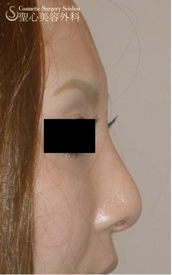 鼻骨削り After 