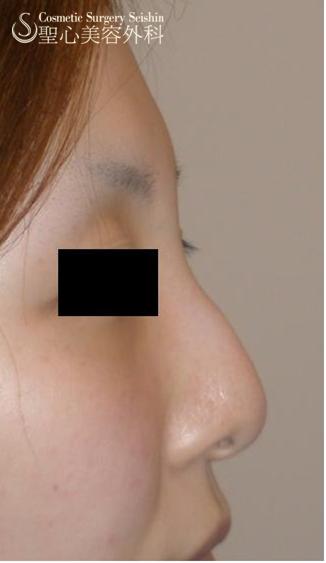 鼻骨削り Before 