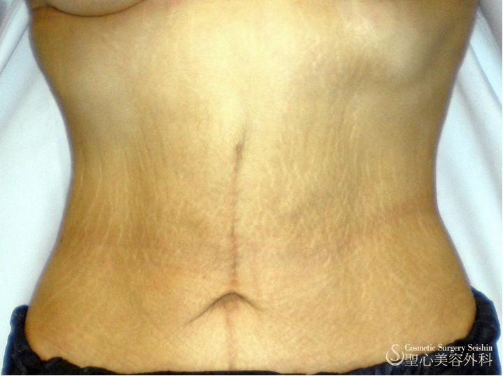 【30代女性：肉割れ・たるみ・ハリ】腹部の皮膚タルミ取り手術　＋　ニューダーマローラー6回 After 