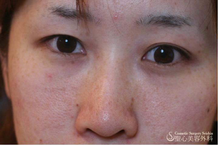 鼻プロテーゼ 症例写真 美容整形 美容外科なら聖心美容クリニック 鼻プロテーゼ 症例写真 美容整形 美容外科なら聖心美容クリニック