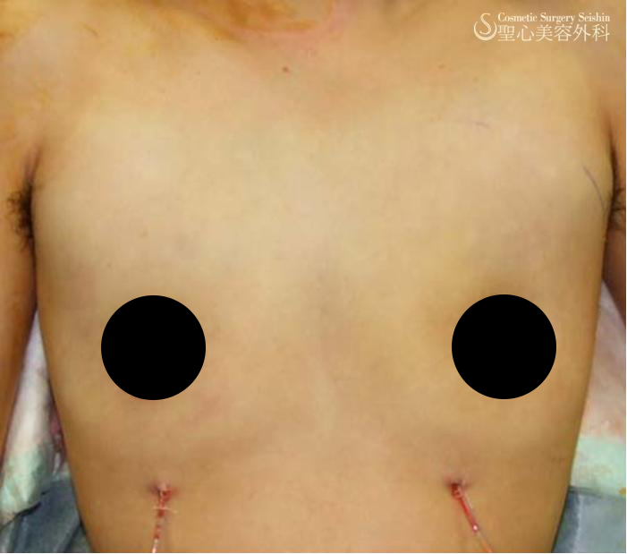 【性同一性障害】乳腺切除（乳房切除）（施術直後） After 