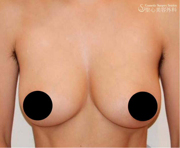【性同一性障害】乳腺切除（乳房切除）（施術直後） Before 