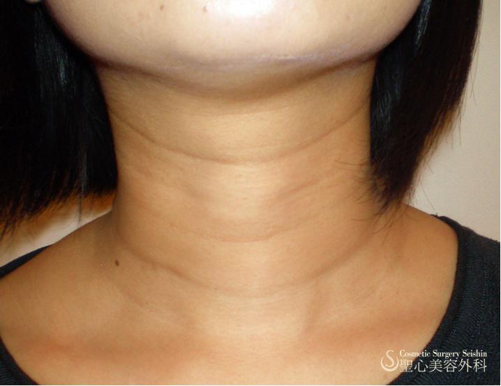 【30代・女性】プレミアムPRP皮膚再生療法（首の横皺） Before 
