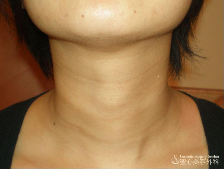 【30代・女性】プレミアムPRP皮膚再生療法（首の横皺） After 