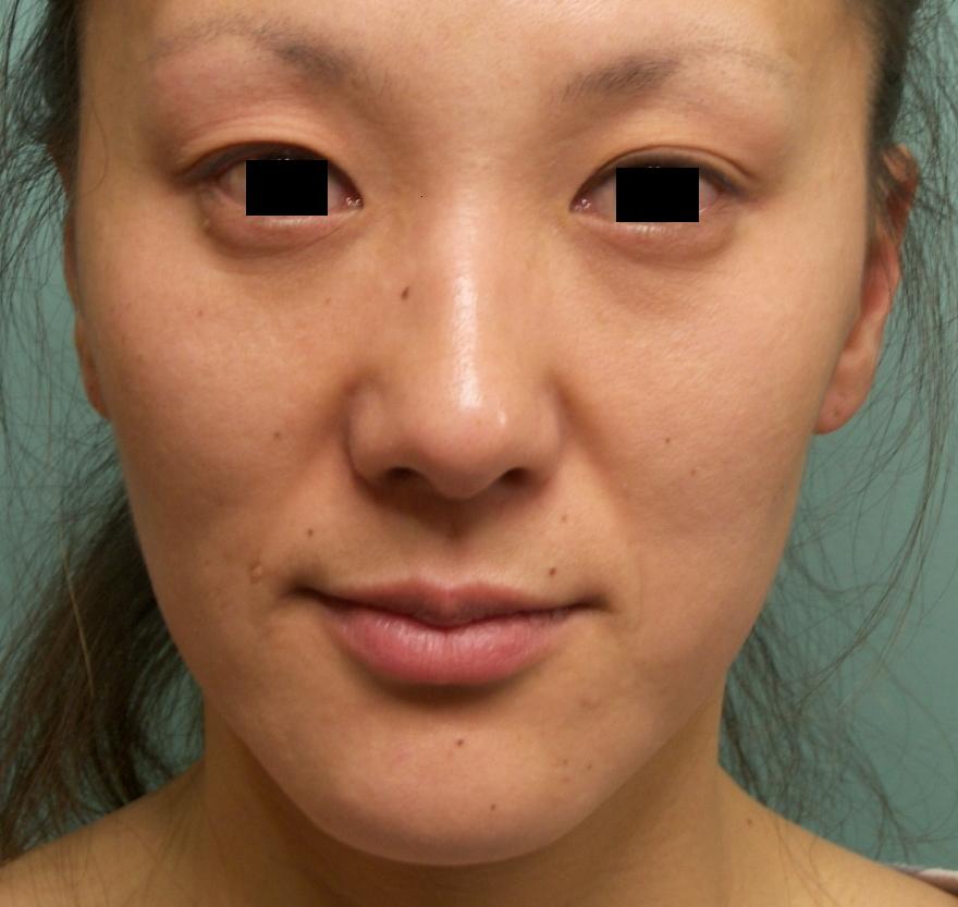 ３０代 若返り 二重埋没法 プレミアムprp 症例写真 美容整形 美容外科なら聖心美容クリニック