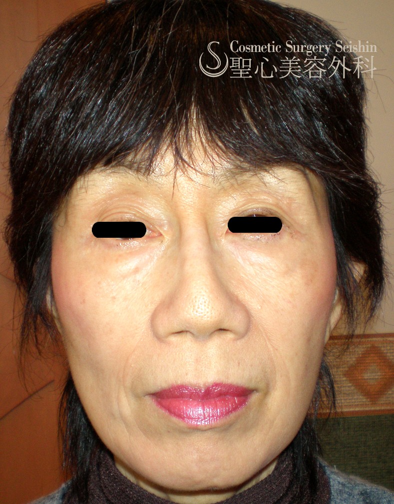 【60歳代：目の上の凹み・頬の凹み】脂肪注入 After 