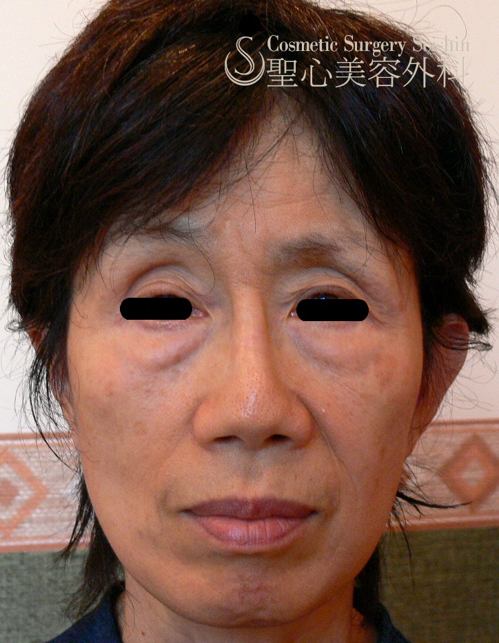 60歳代 目の上の凹み 頬の凹み 脂肪注入 症例写真 美容整形 美容外科なら聖心美容クリニック