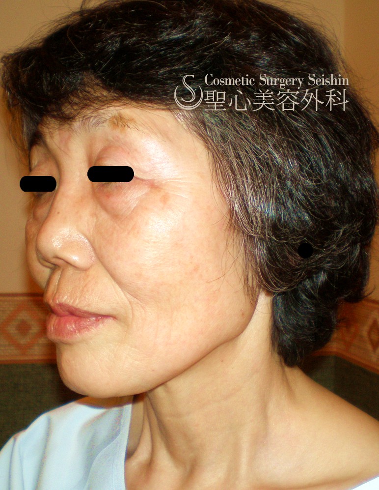 【60代：頬の弛み・皺】プレミアムフェイスリフト＋頬の小皺にP-PRP Before 