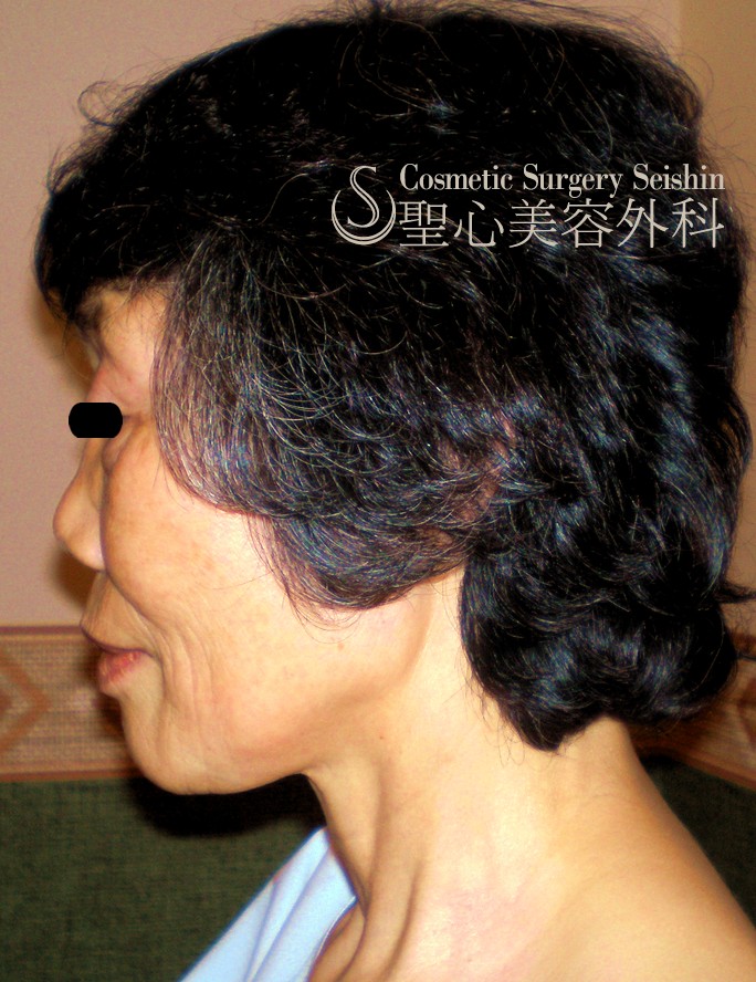 【60代：頬の弛み・皺】プレミアムフェイスリフト＋頬の小皺にP-PRP Before 