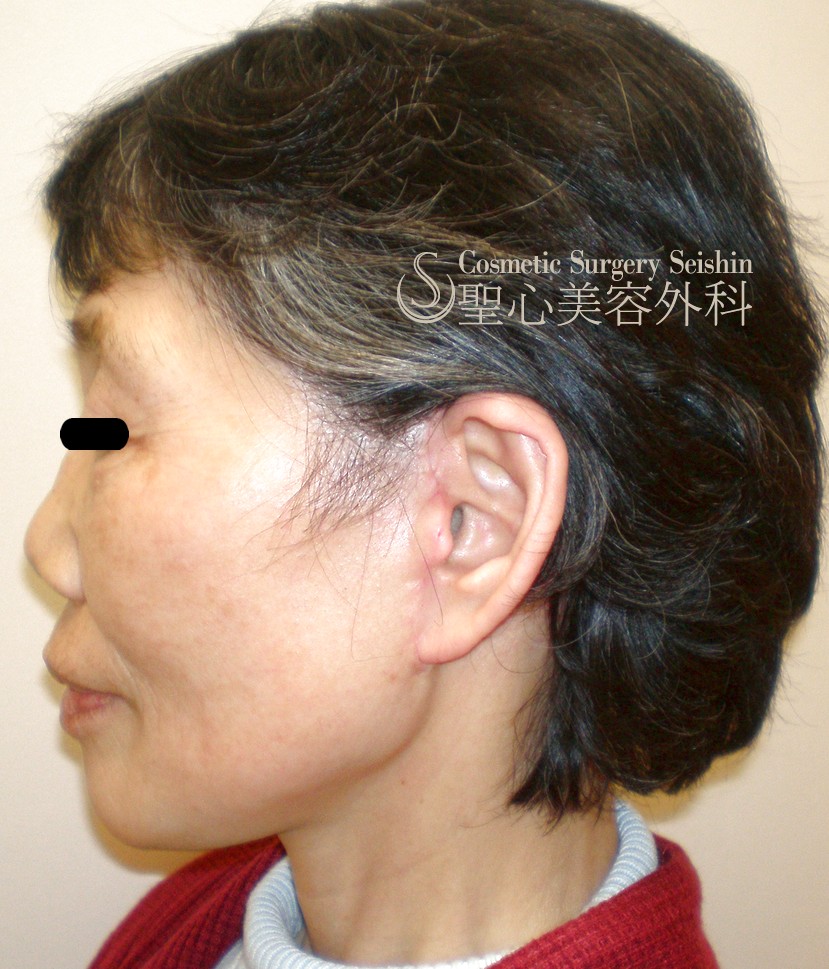 【60代：頬の弛み・皺】プレミアムフェイスリフト＋頬の小皺にP-PRP After 