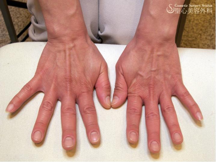 【手の甲】プレミアムPRP（札幌院） Before 