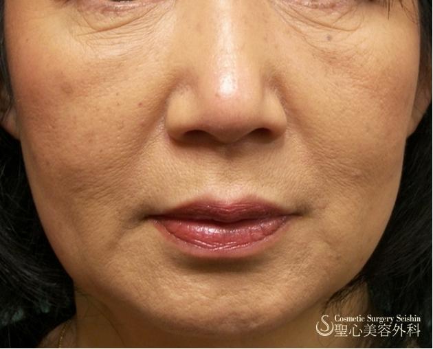 【50代・若返り】プレミアムPRP皮膚再生療法 After 