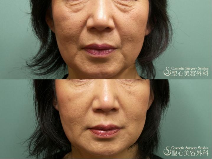 【50代・若返り】プレミアムPRP皮膚再生療法 After 
