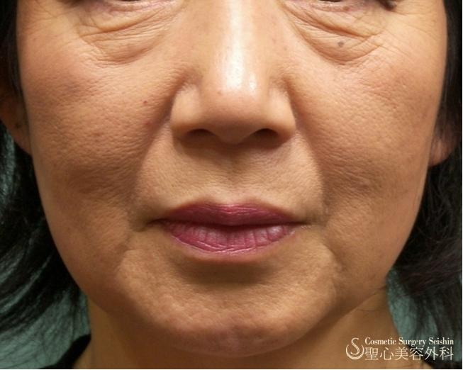 【50代・若返り】プレミアムPRP皮膚再生療法 Before 