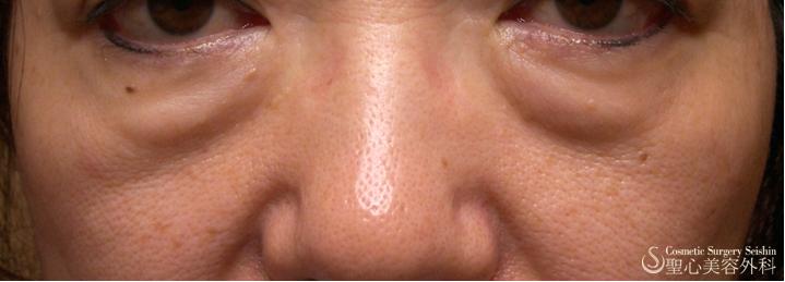 【三白眼がある症例】ハムラ変法（札幌院） Before 