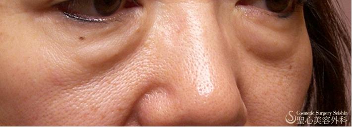 【三白眼がある症例】ハムラ変法（札幌院） Before 