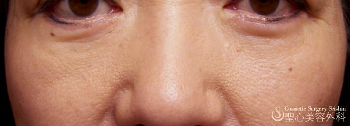 【三白眼がある症例】ハムラ変法（札幌院） After 