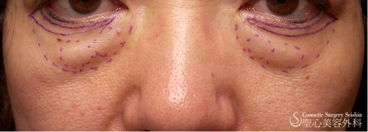 【三白眼がある症例】ハムラ変法（札幌院） Before 