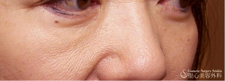 【三白眼がある症例】ハムラ変法（札幌院） After 