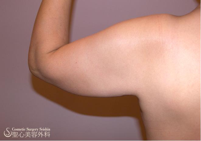 【60代女性・二の腕】ボディージェット脂肪吸引（3ヶ月後） Before 