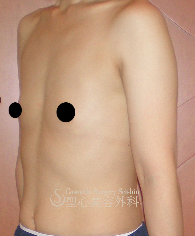 【36歳女性】セリューション豊胸術（脂肪幹細移植） Before 