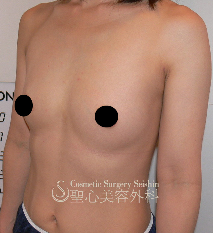 【36歳女性】セリューション豊胸術（脂肪幹細移植） After 
