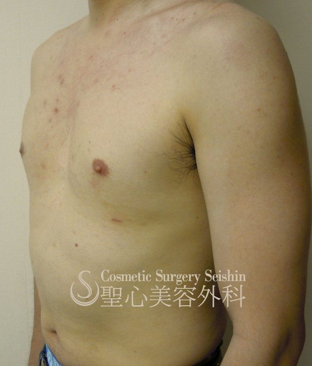 【30歳代男性・（偽性）女性化乳房】脂肪吸引による治療（1ヶ月半後） After 