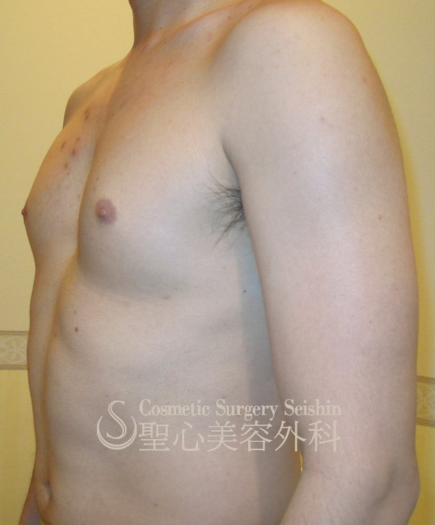 【30歳代男性・（偽性）女性化乳房】脂肪吸引による治療（1ヶ月半後） Before 