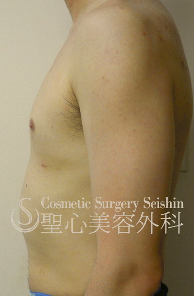 【30歳代男性・（偽性）女性化乳房】脂肪吸引による治療（1ヶ月半後） After 