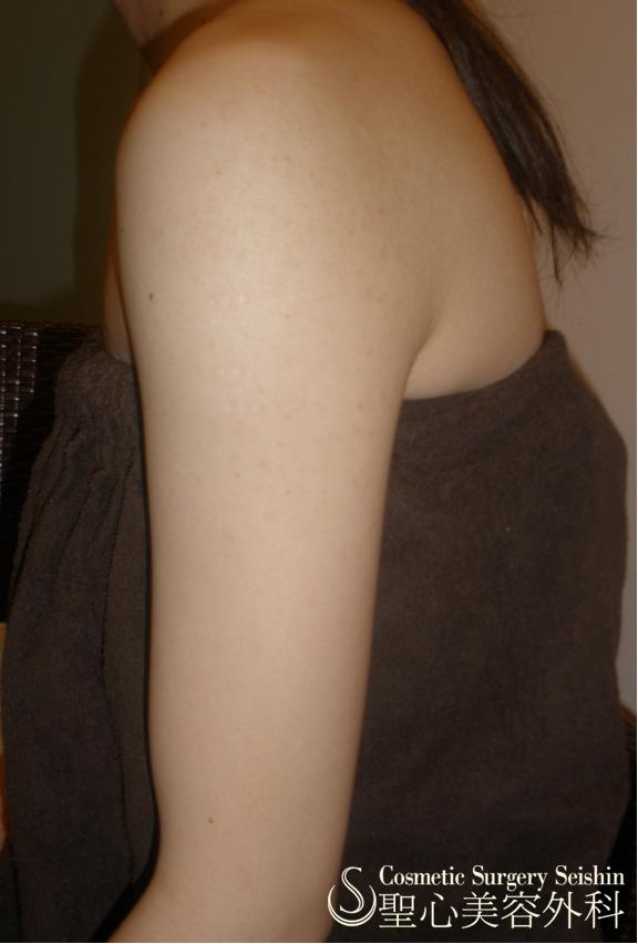 毛孔性苔癬（腕のぶつぶつ） After 