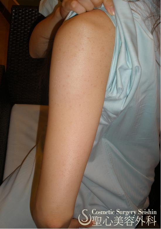 毛孔性苔癬（腕のぶつぶつ） Before 
